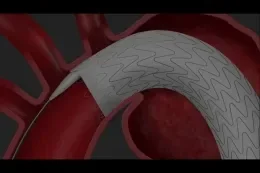 GORE® TAG® Conformable Thoracic Stent Graft with ACTIVE CONTROL System deployment animation