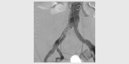 Widely patent arteries demonstrating VBX Stent Graft flexibility and radial strength in a highly tortuous vessel