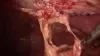 POST-OPERATIVE VIEW: 60-DAYS POST-IMPLANTATION – ERIC MALLICO, M.D. FACS video thumbnail