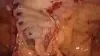 POST-OPERATIVE VIEW: 79-DAYS POST-IMPLANTATION – ERIC MALLICO, M.D. FACS video thumbnail
