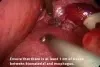 GORE BIO-A Tissue Reinforcement