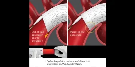 Angulation* and Apposition
