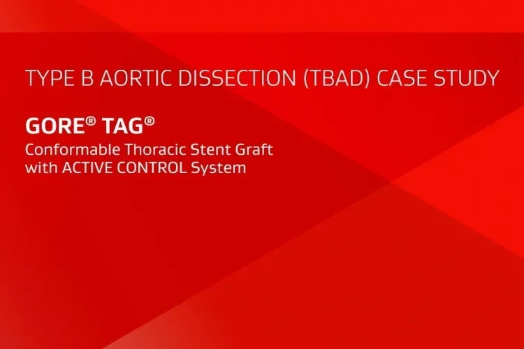 TYPE B AORTIC DISSECTION (TBAD) CASE STUDY