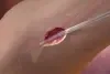 GORE Hybrid Vascular Graft