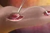 GORE Hybrid Vascular Graft