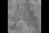 kissing stents imaging