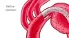 Thumbnail of Hemodynamic Flow