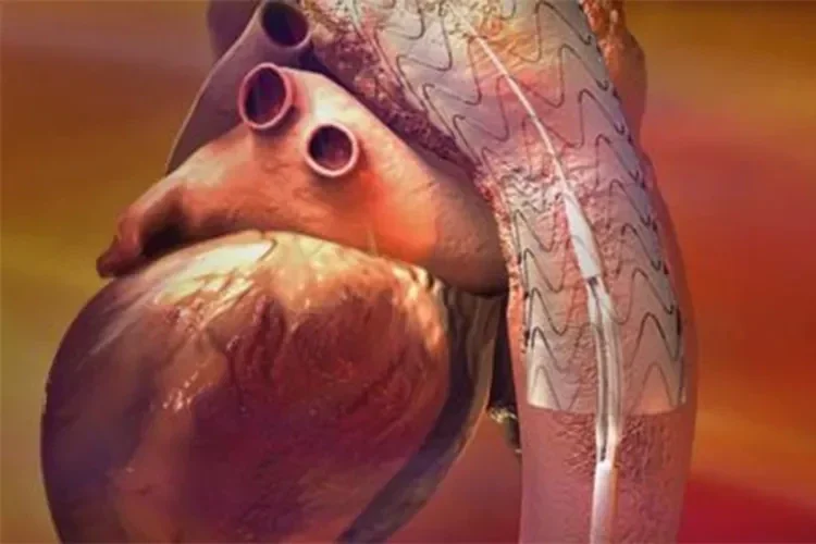 GORE TAG Thoracic Endoprosthesis