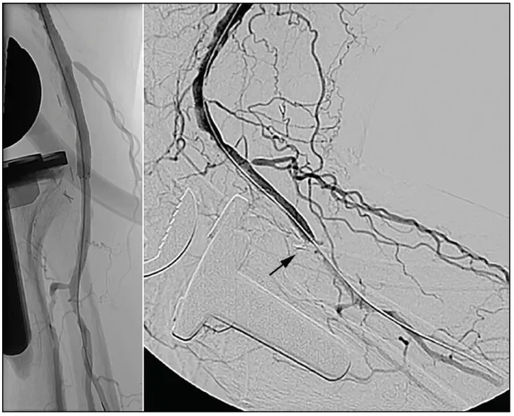 BARD LIFESTENT Vascular Stent System