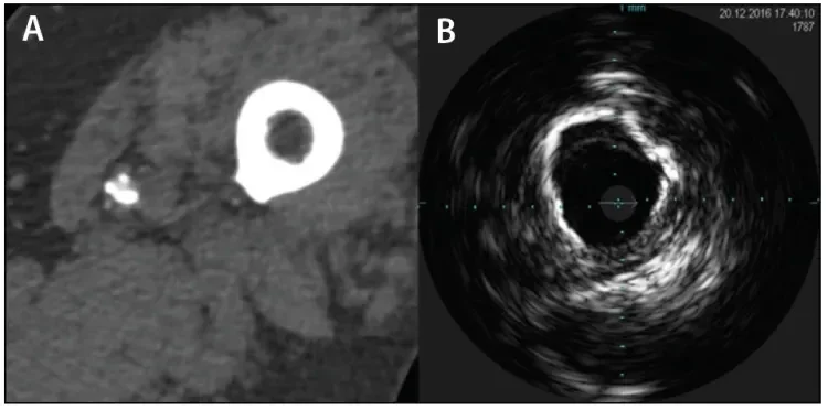 CTAimage IVUS