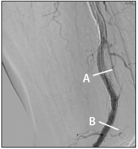 DSA image IVUS