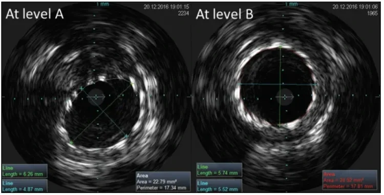 GORE TIGRIS Vascular Stent at levels A and B
