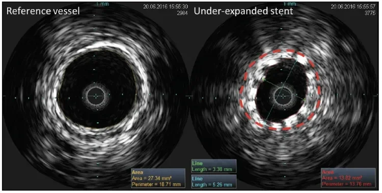 IVUS images of a conventional nitinol stent in the distal SFA