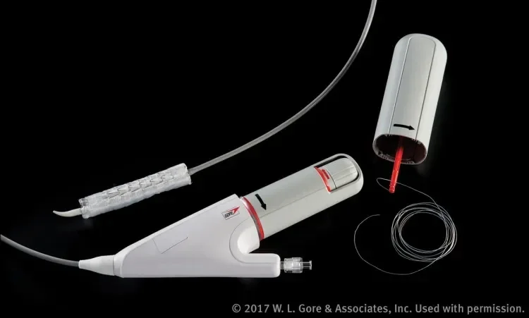 The nested handle of the GORE® TAG® Conformable Thoracic Stent Graft with ACTIVE CONTROL System enables stepwise deployment and optional angulation of the device. This figure shows the device deployed to its intermediate diameter after removal of the primary deployment handle.