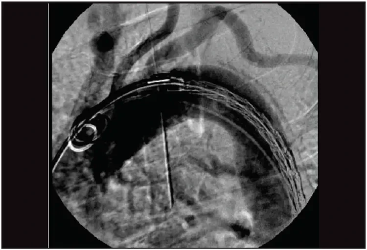 The first 200-mm-long GORE® TAG® Conformable device was placed with the proximal end just below the origin of the left subclavian artery and deployed to its intermediate diameter. The position of the device could be optimized by removing device parallax and adjusting the device position.