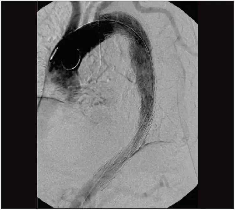 After deployment of the device to its full diameter, the completion angiogram shows adequate placement of the graft in the arch without any endoleak.