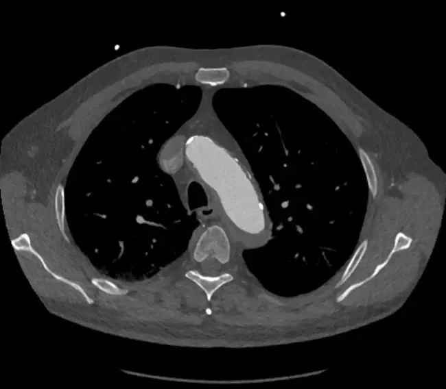 CTA image of the distal aortic arch at the level of the LSA. A clear, thick layer of IMH is seen, excluding a healthy proximal landing zone.