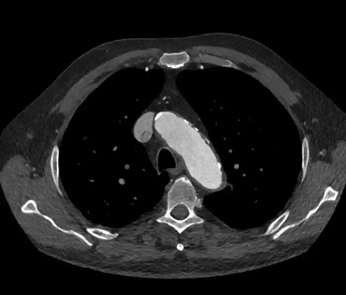 CTA image of the distal aortic arch at the level of the LSA. The thick IMH has almost completely vanished, resulting in a relatively healthy proximal landing zone.