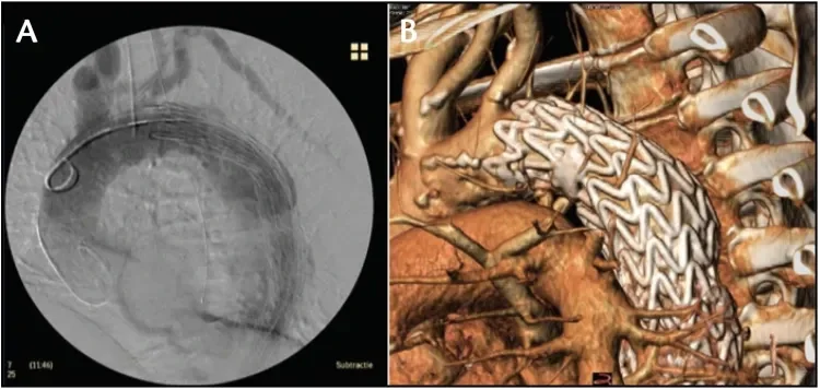 Deployment of the proximal device at intermediate diameter with continuous blood flow (A) and at full diameter (B).