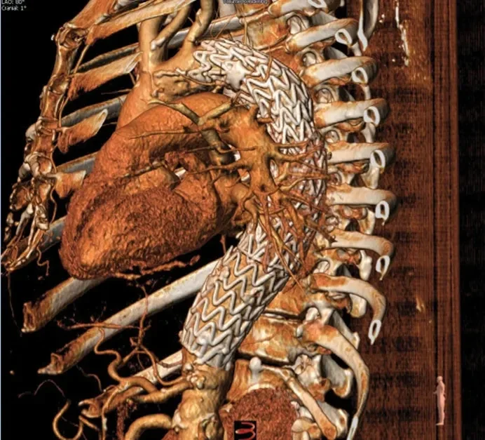 Postoperative CTA demonstrating successful exclusion of the aneurysm with optimal device placement at both proximal and distal landing zones.