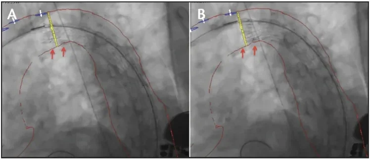 Intraoperative fluoroscopy before (A) and after (B) angulation and refinement of stent graft position at the intermediate stage of deployment. The red arrows indicate the improved apposition of the device at the inner arch curvature.