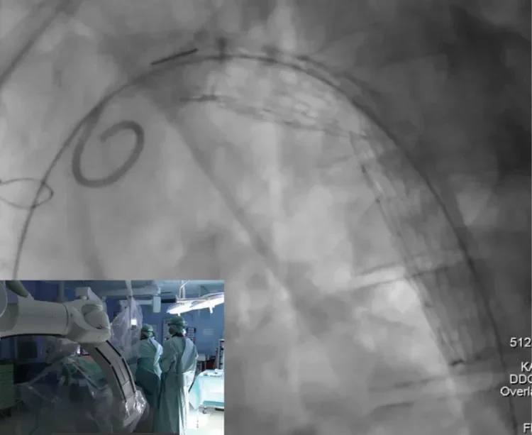 On intraoperative fluoroscopy, parallax correction of the C-arm was adjusted according to the gold band marker on the proximal end of the device. A perpendicular angle to the aorta can be confirmed when the gold band appears as a straight line, rather than an ellipse.