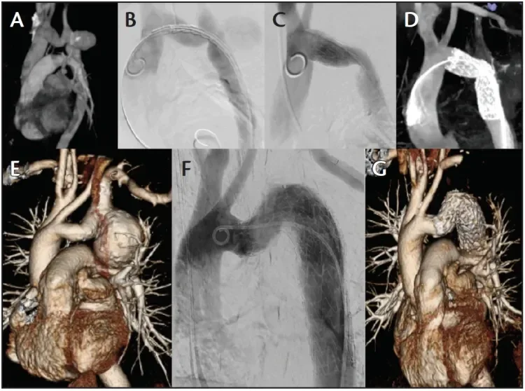 Preoperative three-dimensional (3D) CTA (A), intraoperative digital subtraction angiography at predeployment (B) and after full deployment (C), and intraoperative on-table cone-beam CTA (D) of a successful GORE® TAG® Conformable Thoracic Stent Graft implantation in a 40-year-old man with a postcoarctation aneurysm of 42 mm. The bottom three images demonstrate preoperative 3D CT reconstruction (E), completion angiography (F), and postoperative 3D CT reconstruction (G).