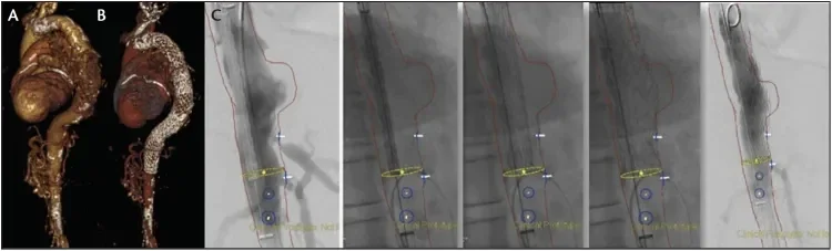 Pre- and postoperative CT scans shows the thoracic aneurysm of the patient before (A) and after (B) treatment. Intraoperative placement of the distal device at the level of the celiac trunk (C).