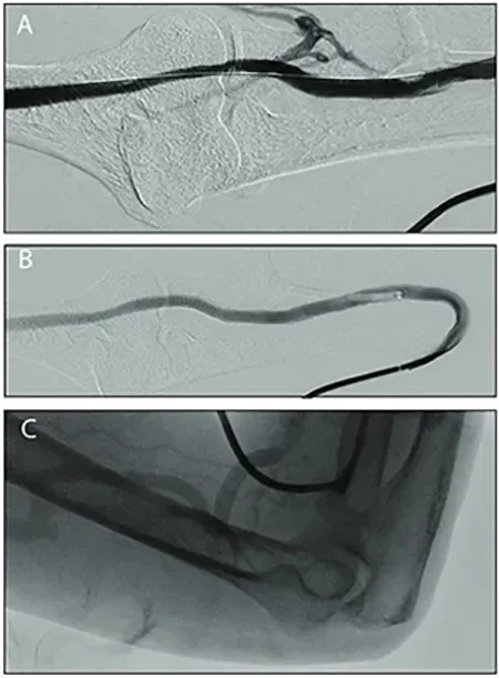 venous stenosis