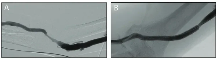 venous anastomotic stenosis
