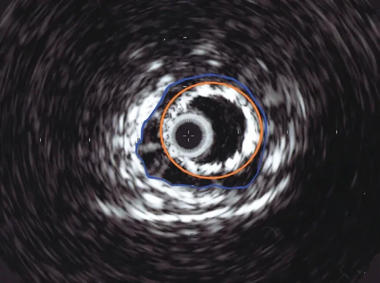 Intravascular Ultrasound