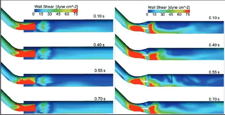 Wall Shear Stress during cardiac cycle