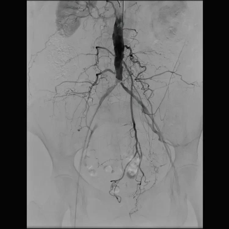 Figure 1. Aortoiliac angiogram showing severe calcified bilateral common iliac artery ostial stenoses.