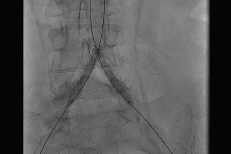 Figure 2. Deployment of bilateral common iliac artery GORE® VIABAHN® VBX Balloon Expandable Endoprosthesis kissing covered stents.