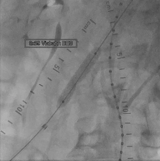 Left Coronary