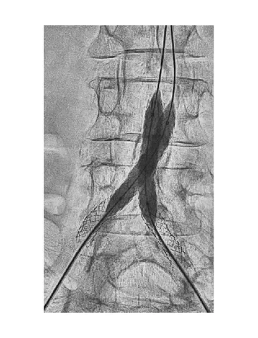 Final post-dilation of the GORE® VIABAHN® VBX Balloon Expandable Endoprosthesis