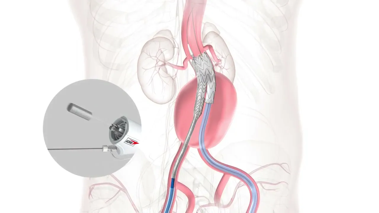 ゴア® エクスクルーダー® ステントグラフト留置動画