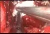 GORE PRECLUDE MVP Dura Substitute