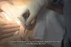 ventral hernia repair