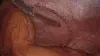 POST-OPERATIVE VIEW: 13-MONTHS POST-IMPLANTATION – ERIC MALLICO, M.D. FACS  video thumbnail