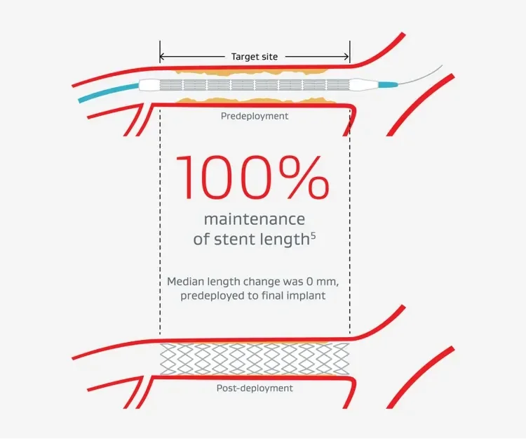 100% maintenance of stent length