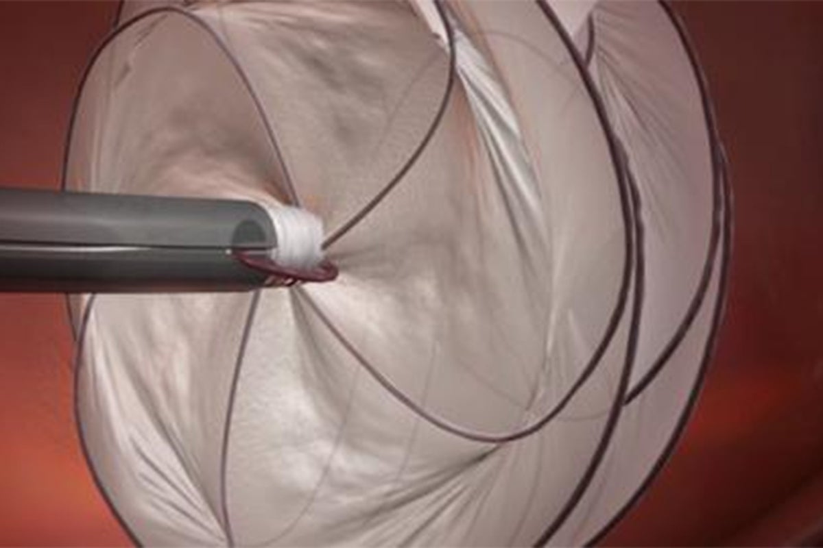 WATCH how the GORE CARDIOFORM Septal Occluder is implanted