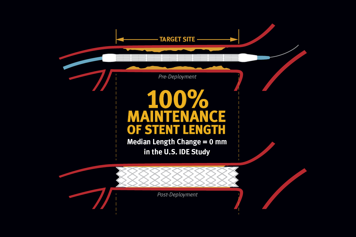 100% maintenance of stent length