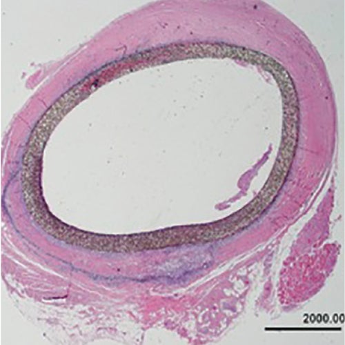Distal anastomosis occluded