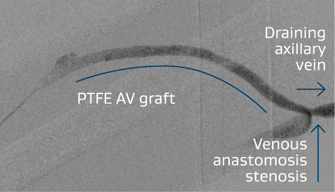 Right brachialaxillary AV graft with stenosis at the venous anastomosis