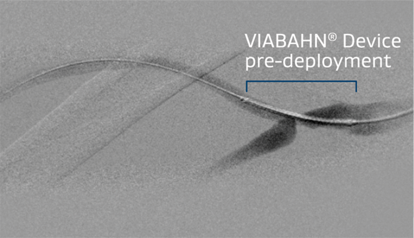 GORE® VIABAHN® Endoprosthesis with Heparin Bioactive Surface advanced across the venous anastomosis