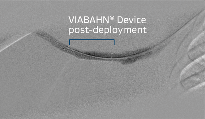 Improved flow and resolution of recoil post VIABAHN® Device placement
