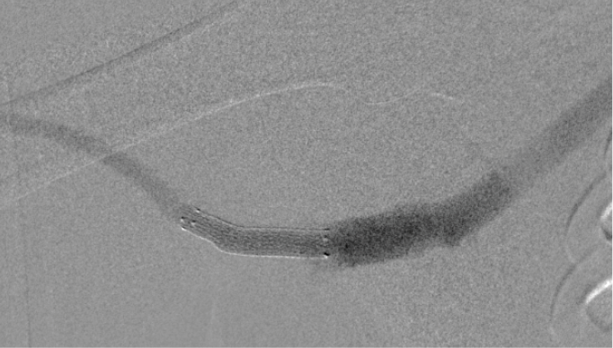 Patent VIABAHN® Device 13-months post-placement