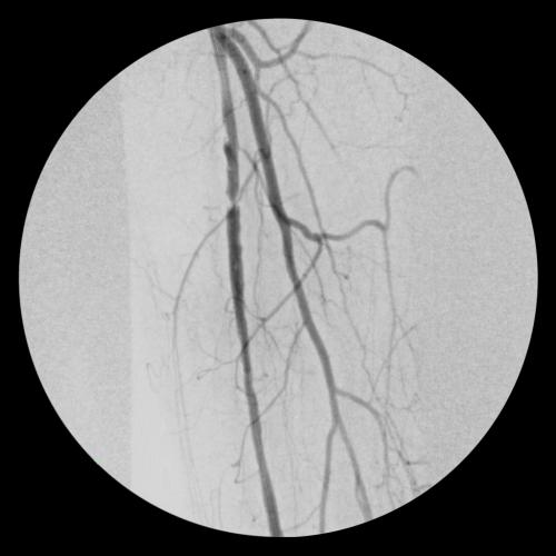 Severe peripheral arterial disease (PAD)