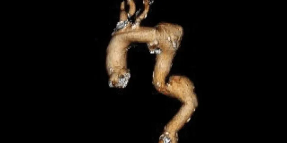 TAG_Adapting_to_aortic_anatomy_pre-treatment